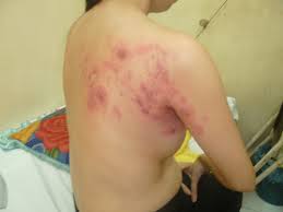 Nguyên nhân và cách điều trị bệnh Zona thần kinh